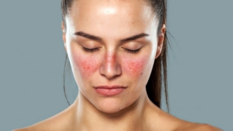 Omega 3 có thể ngăn ngừa bệnh lupus ban đỏ